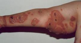 WT: Bullous pemphigoid